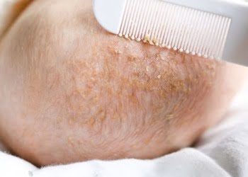 How to Escape Cradle Cap In Babies – Your Ultimate Guide